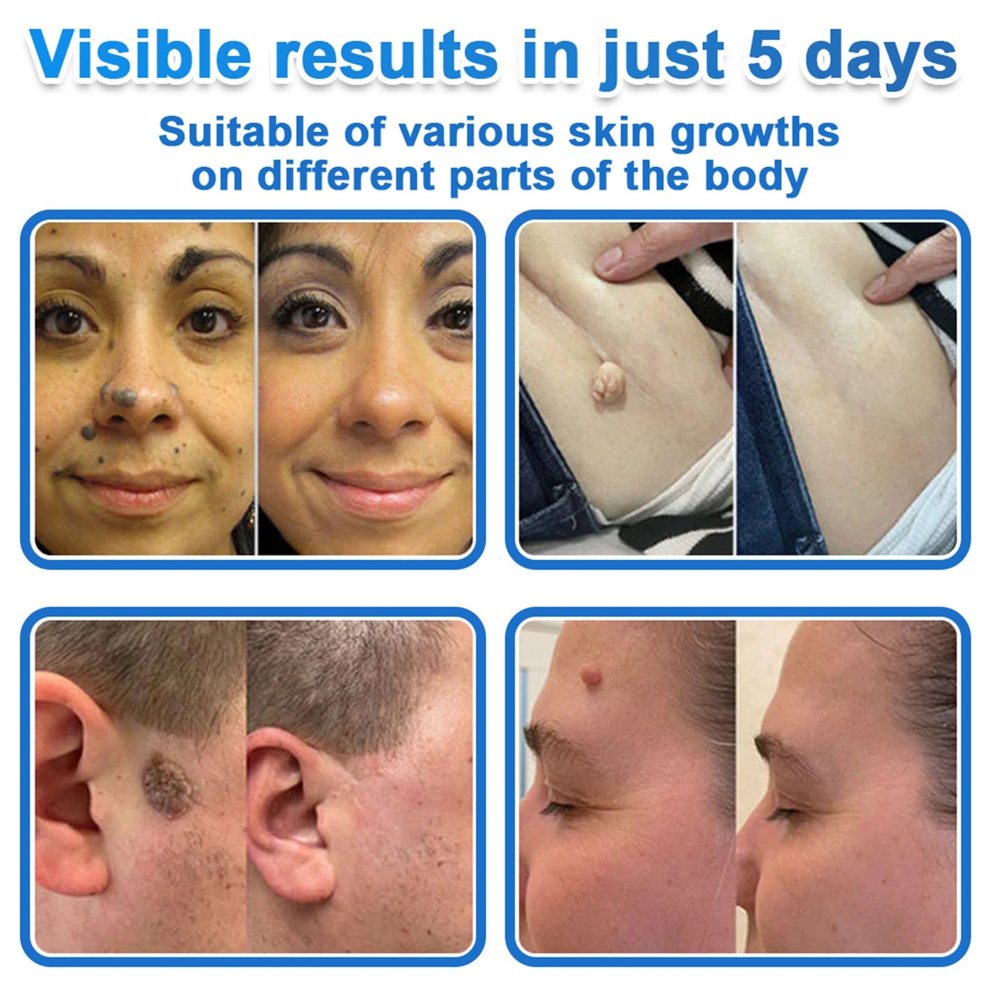 ✅ DR.Fachmer® 2-in-1 Microneedle & Hydrocolloid Patch | Raised Moles,Acne,  Flat Warts & Skin Tags Remover | Improves Wrinkles, Scars & Blemishes | Invisible Pimple Patches for Face & Body