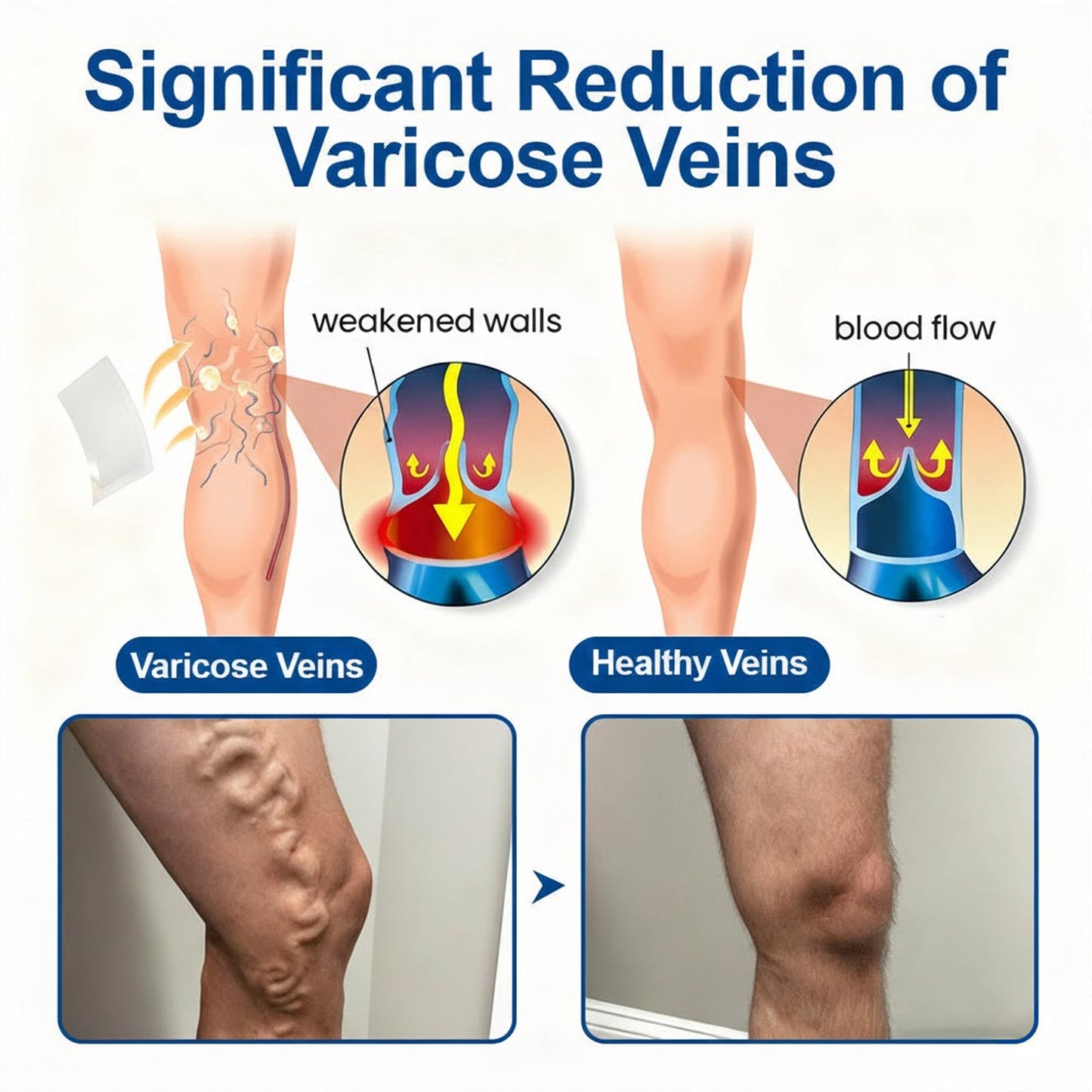 👨‍⚕️GFOUK® VeinEase Microneedle Care Patch⚡Instant Relief, Long-Term Results
