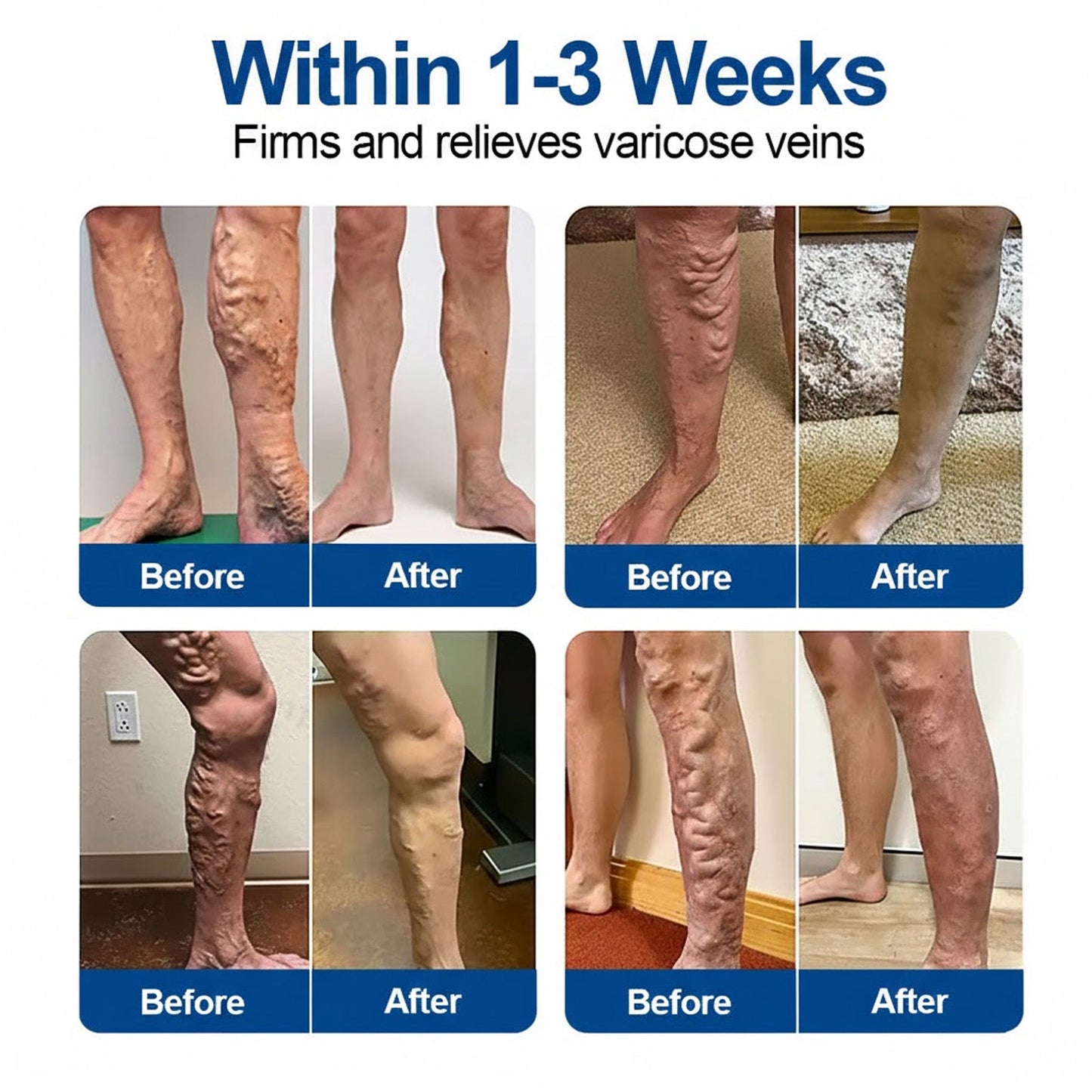 👨‍⚕️GFOUK® VeinEase Microneedle Care Patch⚡Instant Relief, Long-Term Results