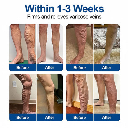 👨‍⚕️GFOUK® VeinEase Microneedle Care Patch⚡Instant Relief, Long-Term Results