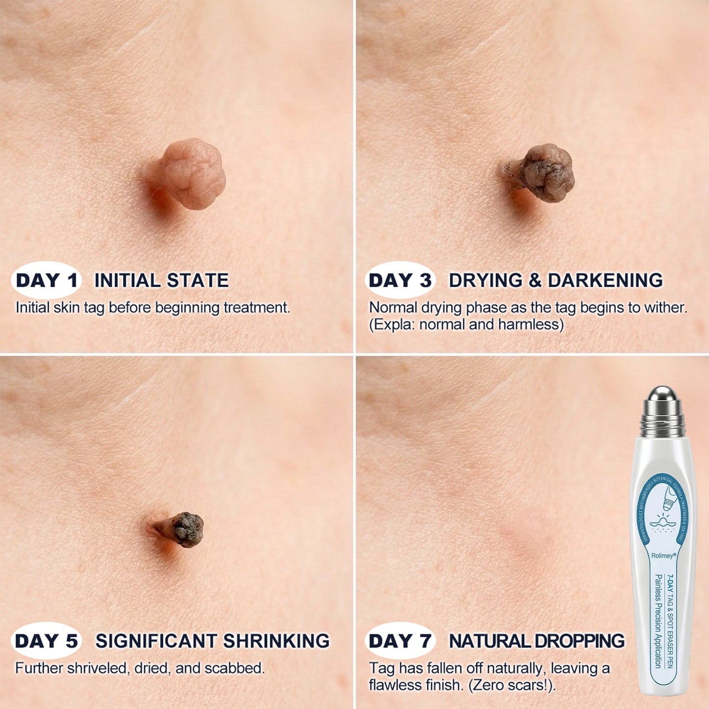 💕Official Brand Shop | Rolimey® 7-Day Roll-On for Skin Spots and Skin Tags – Pain-Free & Scar-Free