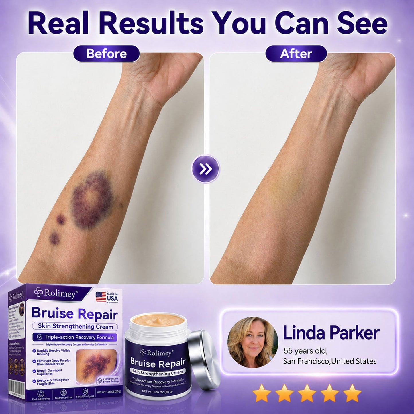 👨‍⚕️Over 100,000 units sold💕 - Rolimey® cream to repair bruises and strengthen the skin